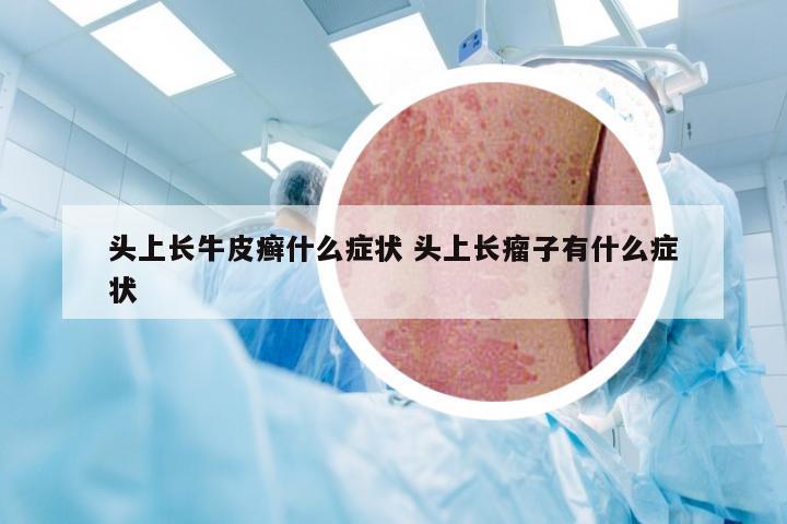 头上长牛皮癣什么症状 头上长瘤子有什么症状