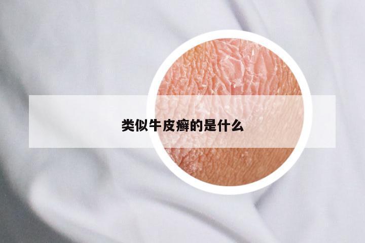 类似牛皮癣的是什么