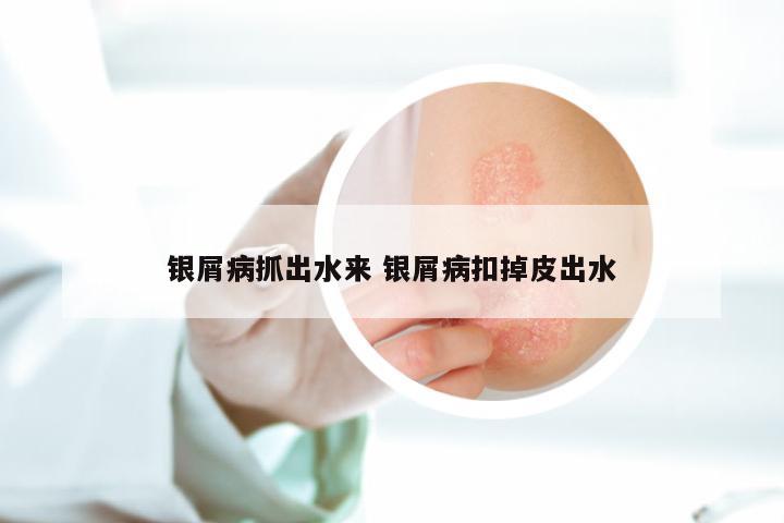 银屑病抓出水来 银屑病扣掉皮出水