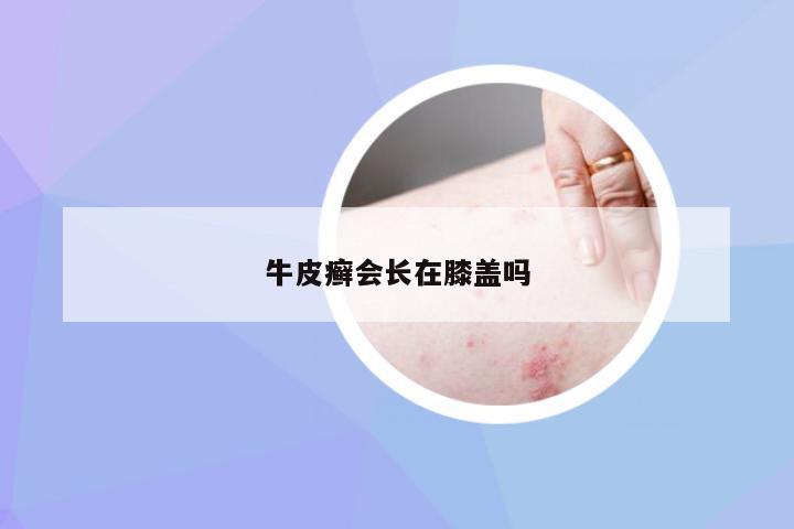 牛皮癣会长在膝盖吗