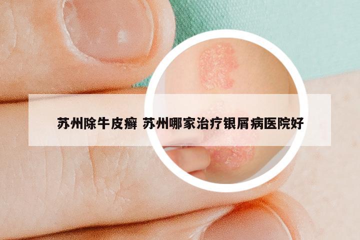 苏州除牛皮癣 苏州哪家治疗银屑病医院好