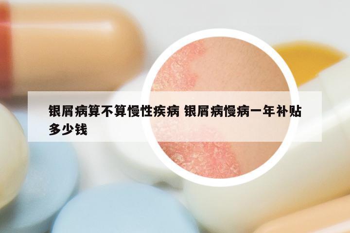 银屑病算不算慢性疾病 银屑病慢病一年补贴多少钱