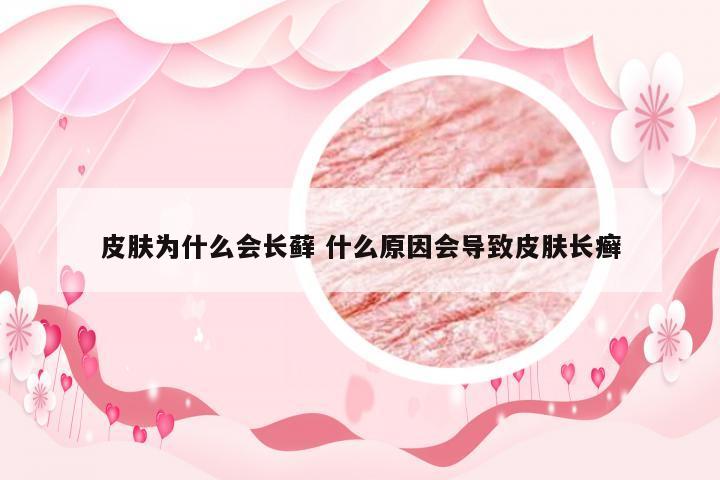 皮肤为什么会长藓 什么原因会导致皮肤长癣