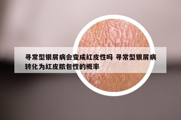 寻常型银屑病会变成红皮性吗 寻常型银屑病转化为红皮脓包性的概率