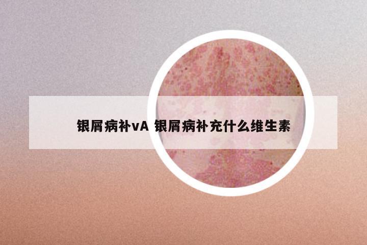 银屑病补vA 银屑病补充什么维生素