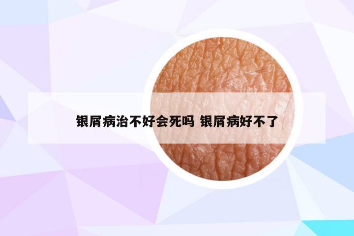银屑病治不好会死吗 银屑病好不了