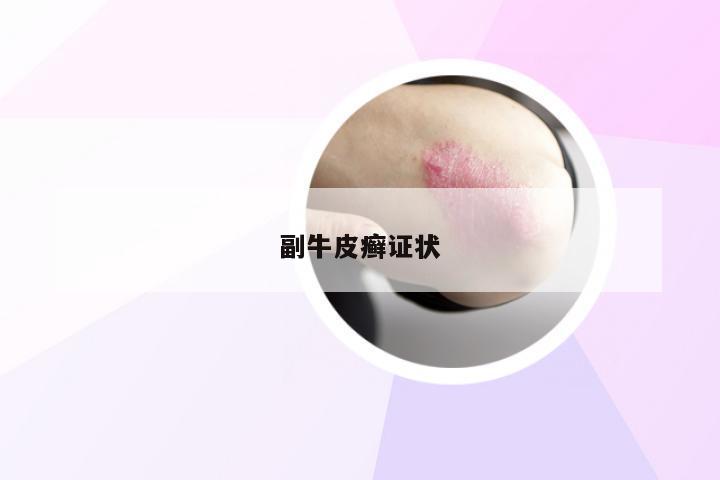 副牛皮癣证状