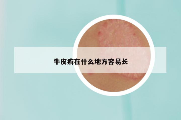 牛皮癣在什么地方容易长