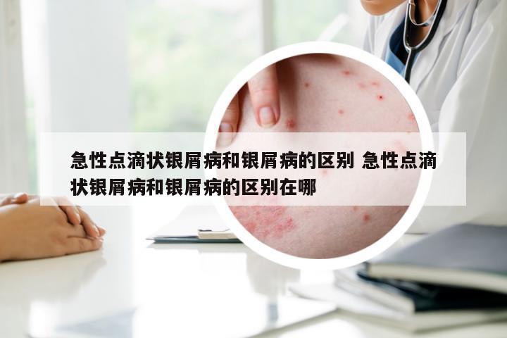 急性点滴状银屑病和银屑病的区别 急性点滴状银屑病和银屑病的区别在哪