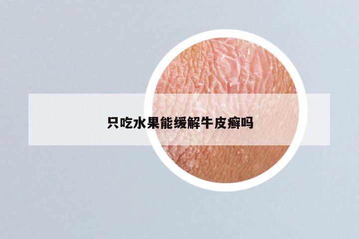 只吃水果能缓解牛皮癣吗
