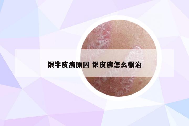 银牛皮癣原因 银皮癣怎么根治