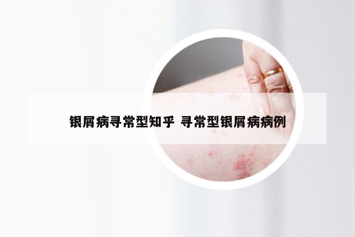 银屑病寻常型知乎 寻常型银屑病病例