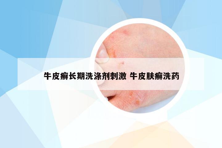 牛皮癣长期洗涤剂刺激 牛皮肤癣洗药