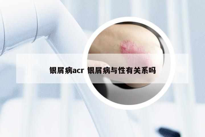 银屑病acr 银屑病与性有关系吗