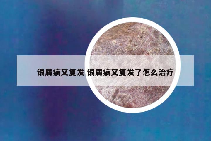 银屑病又复发 银屑病又复发了怎么治疗