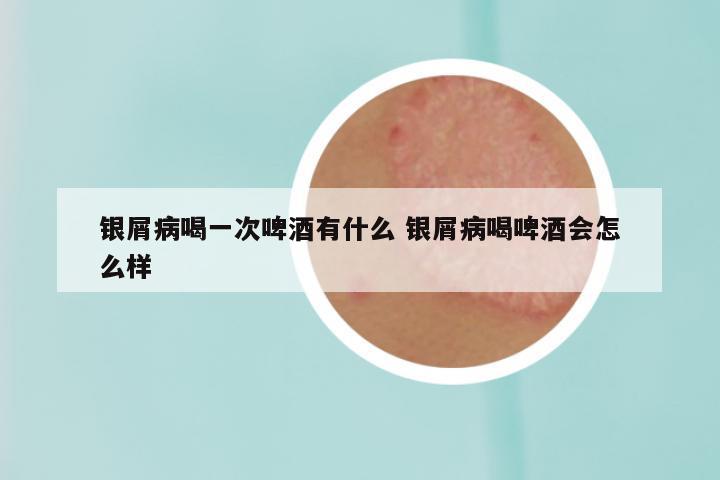 银屑病喝一次啤酒有什么 银屑病喝啤酒会怎么样