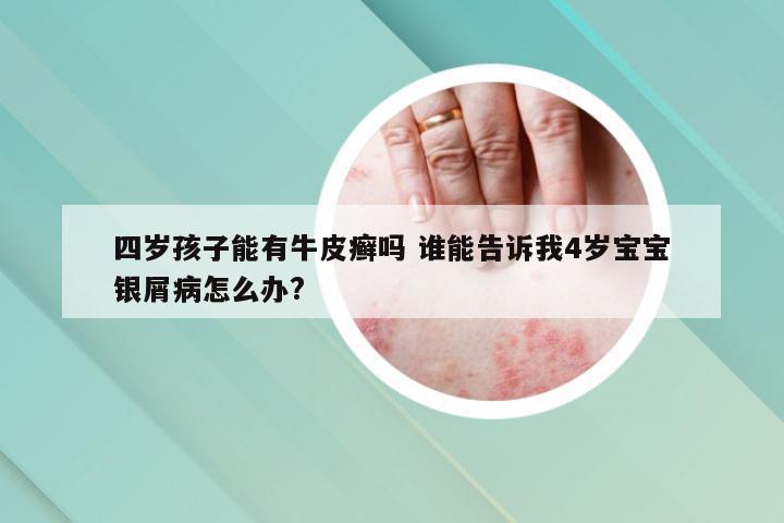 四岁孩子能有牛皮癣吗 谁能告诉我4岁宝宝银屑病怎么办?