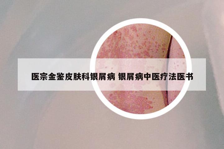医宗金鉴皮肤科银屑病 银屑病中医疗法医书