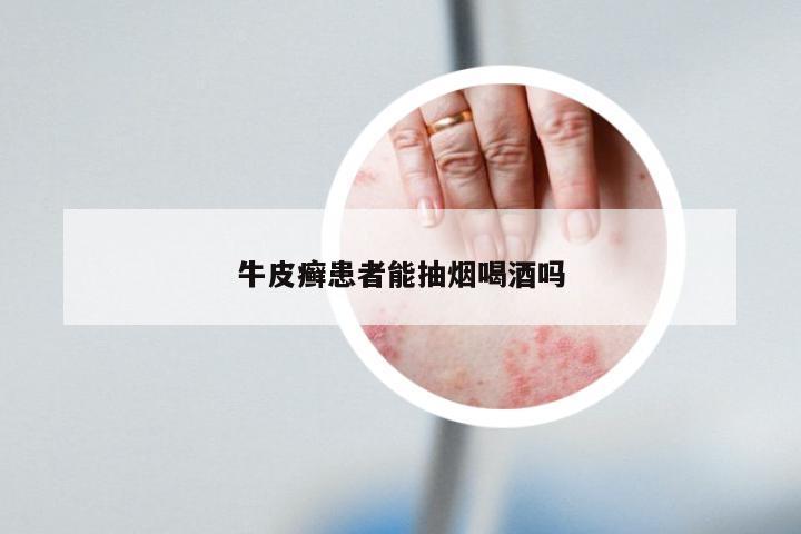 牛皮癣患者能抽烟喝酒吗