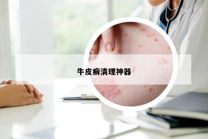 牛皮癣清理神器