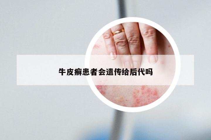 牛皮癣患者会遗传给后代吗