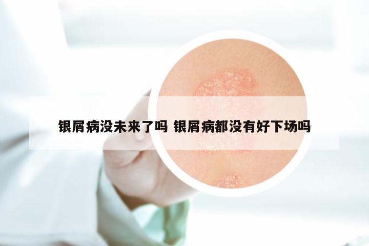 银屑病没未来了吗 银屑病都没有好下场吗