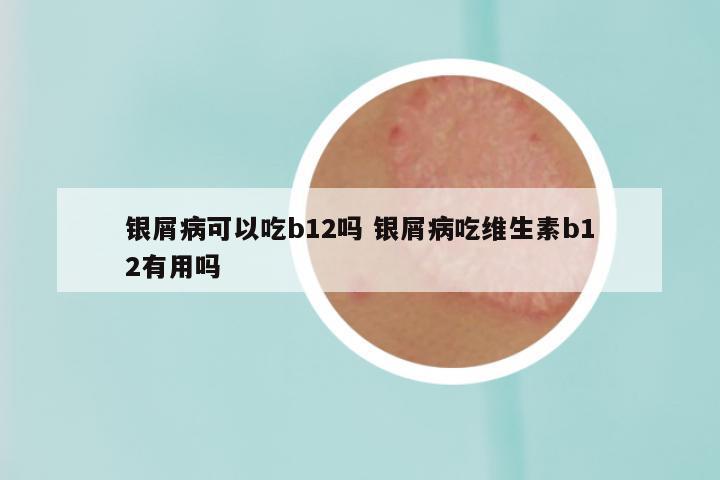 银屑病可以吃b12吗 银屑病吃维生素b12有用吗