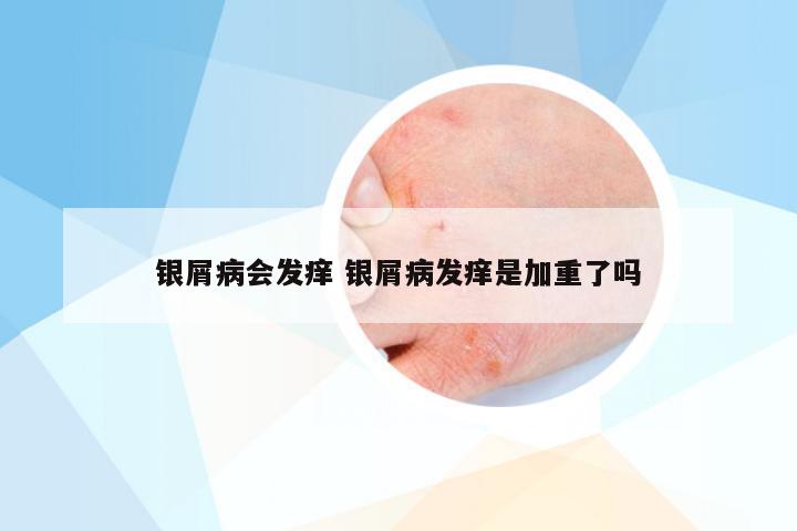 银屑病会发痒 银屑病发痒是加重了吗