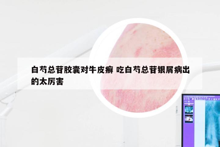 白芍总苷胶囊对牛皮癣 吃白芍总苷银屑病出的太厉害