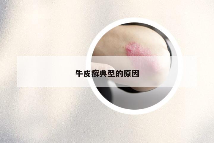 牛皮癣典型的原因