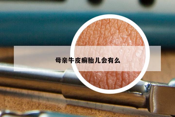 母亲牛皮癣胎儿会有么