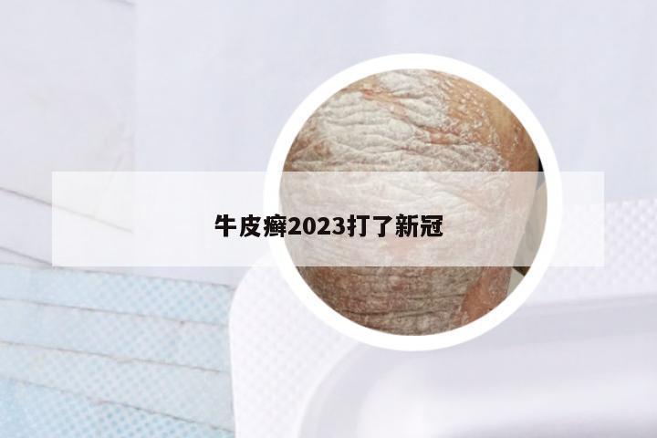 牛皮癣2023打了新冠