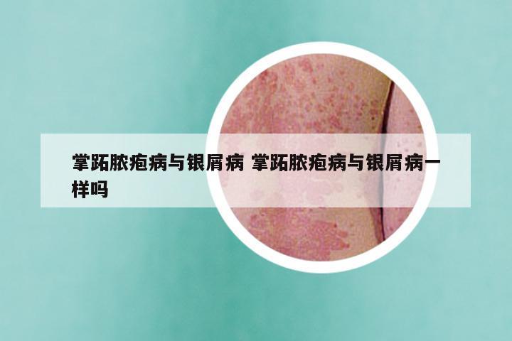 掌跖脓疱病与银屑病 掌跖脓疱病与银屑病一样吗