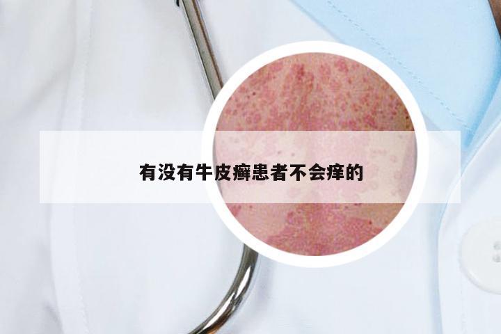 有没有牛皮癣患者不会痒的