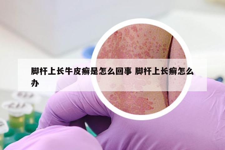 脚杆上长牛皮癣是怎么回事 脚杆上长癣怎么办