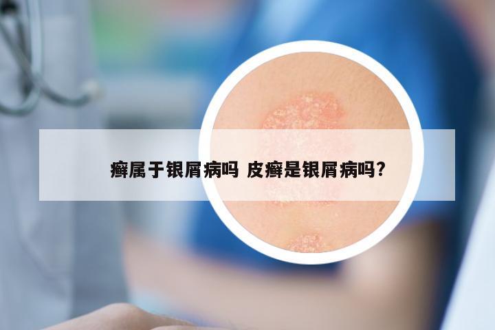 癣属于银屑病吗 皮癣是银屑病吗?