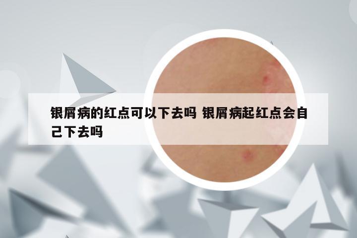 银屑病的红点可以下去吗 银屑病起红点会自己下去吗