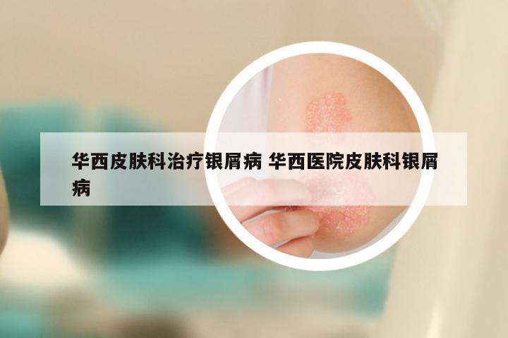华西皮肤科治疗银屑病 华西医院皮肤科银屑病
