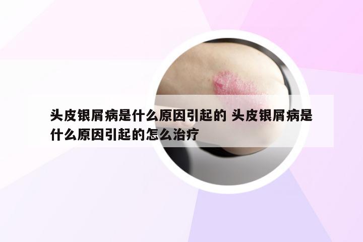 头皮银屑病是什么原因引起的 头皮银屑病是什么原因引起的怎么治疗