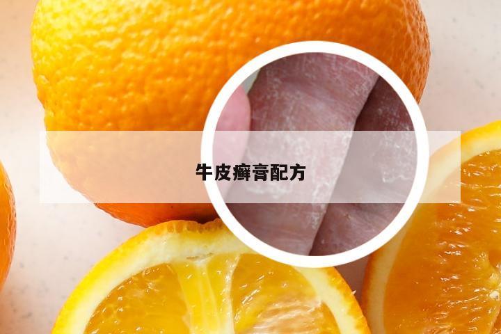 牛皮癣膏配方