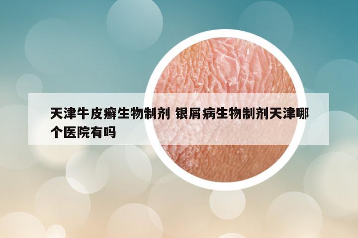 天津牛皮癣生物制剂 银屑病生物制剂天津哪个医院有吗