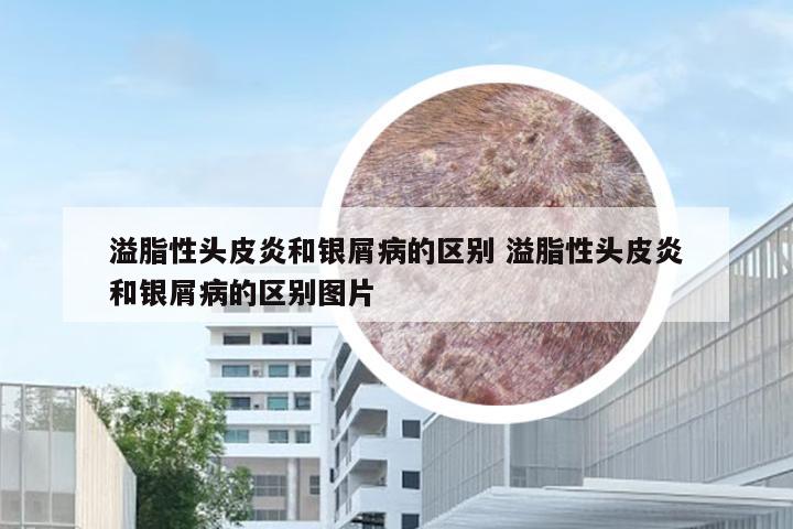 溢脂性头皮炎和银屑病的区别 溢脂性头皮炎和银屑病的区别图片