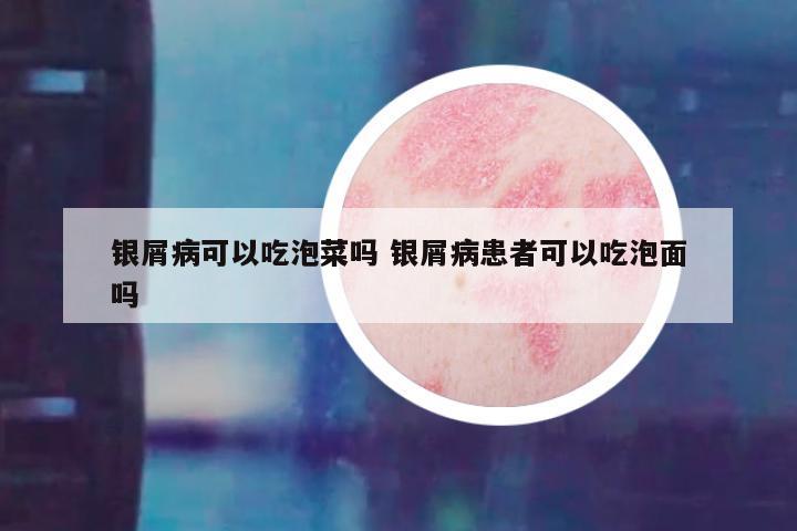 银屑病可以吃泡菜吗 银屑病患者可以吃泡面吗