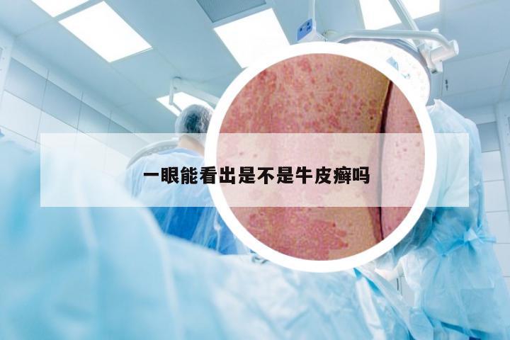 一眼能看出是不是牛皮癣吗