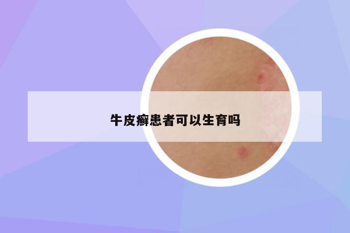 牛皮癣患者可以生育吗