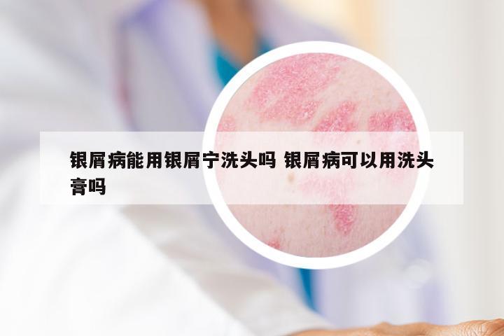 银屑病能用银屑宁洗头吗 银屑病可以用洗头膏吗