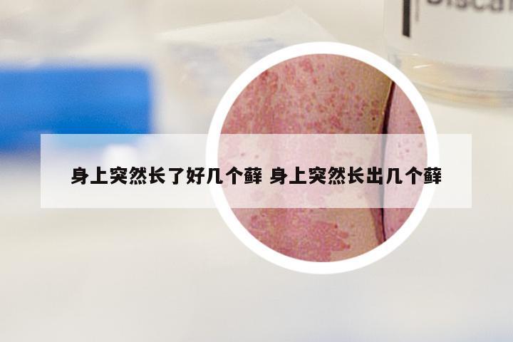 身上突然长了好几个藓 身上突然长出几个藓