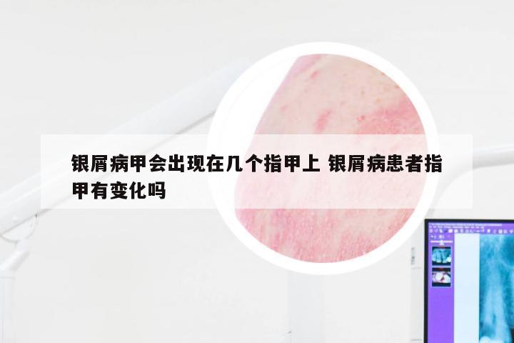 银屑病甲会出现在几个指甲上 银屑病患者指甲有变化吗