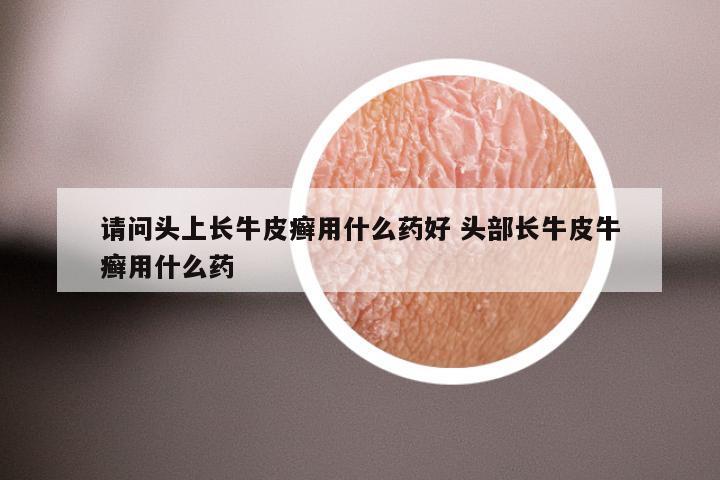 请问头上长牛皮癣用什么药好 头部长牛皮牛癣用什么药