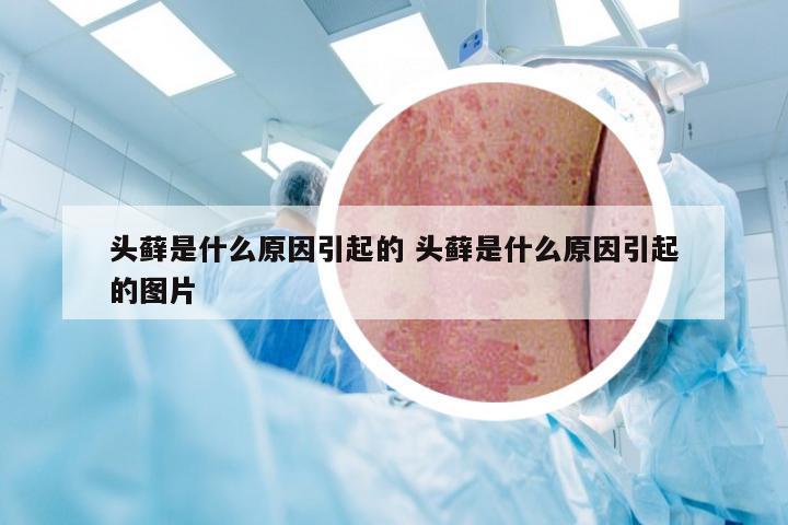 头藓是什么原因引起的 头藓是什么原因引起的图片